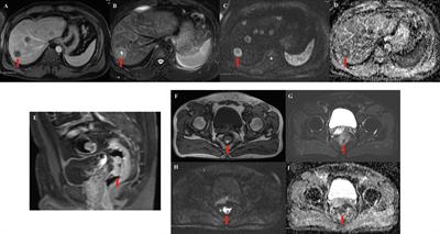 KRAS Gene Copy Number as a Negative Predictive Biomarker for the Treatment of Metastatic Rectal Cancer With Cetuximab: A Case Report